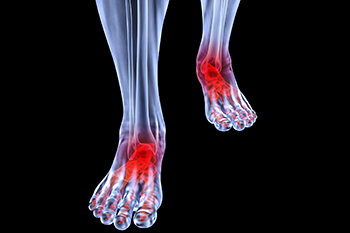 arthritic foot and ankle care treatment in Midtown & Downtown Manhattan: New York, NY 10038 and New York, NY 10036 as well as Forest Hills, NY 11375