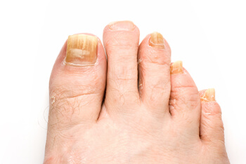 fungus toenails treatment in Midtown & Downtown Manhattan: New York, NY 10038 and New York, NY 10036 as well as Forest Hills, NY 11375 area