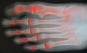 Can Osteoarthritis Occur in the Ankles?